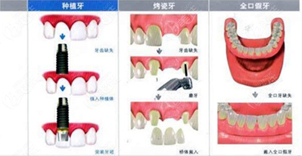 固定假牙可以用30年嗎