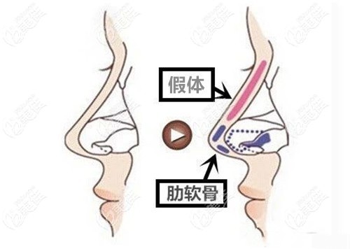 關(guān)注西寧做鼻綜合醫(yī)院哪家好的同時(shí)隆鼻價(jià)格也得考慮下