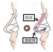 關(guān)注西寧做鼻綜合醫(yī)院哪家好的同時(shí)隆鼻價(jià)格也得考慮下
