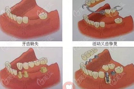 70岁老人全口假牙价目表