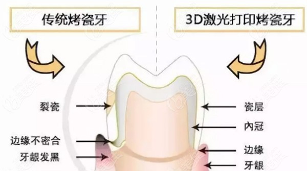 從3d打印全口義齒的價格及優(yōu)缺點