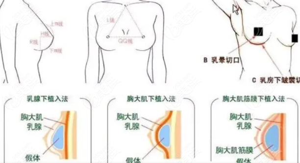 西安哪个医生做隆胸手术好