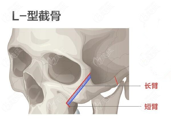 顴骨高做顴骨內(nèi)推手術(shù)選擇L型截骨和I型截骨哪種好