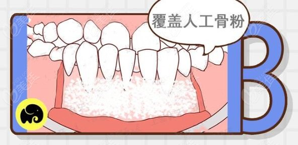 牙齒骨開窗骨開裂可以矯正嗎