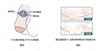 怎樣延長陰莖長度