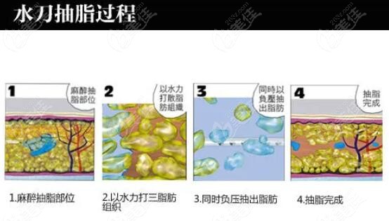 2022郑州抽脂手术价格表