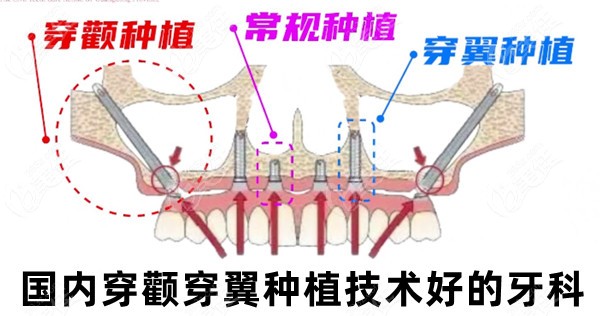 国内穿颧穿翼种植技术好的牙科有鼎植/劲松/暨大穗华/正夫口腔