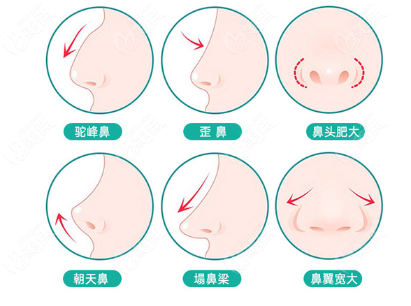 南陽隆鼻好的醫(yī)生來說說做假體隆鼻手術(shù)需要多少錢