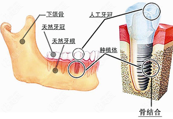 正規(guī)醫(yī)院鑲牙收費標準