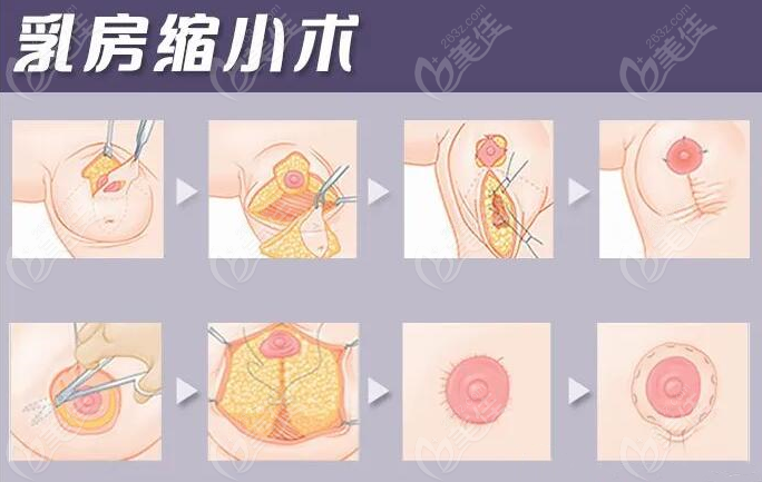 乳房花苞精雕術(shù)的價格是比傳統(tǒng)雙環(huán)貴點