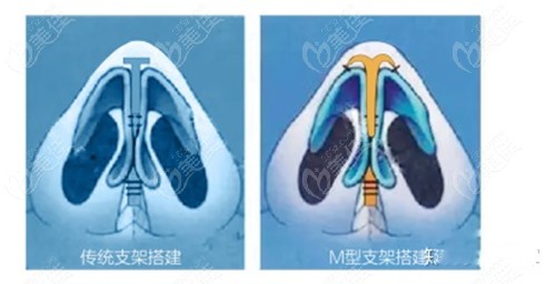 广西爱思特王楷医生做鼻子怎么样