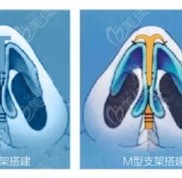 廣西愛(ài)思特王楷醫(yī)生做鼻子怎么樣