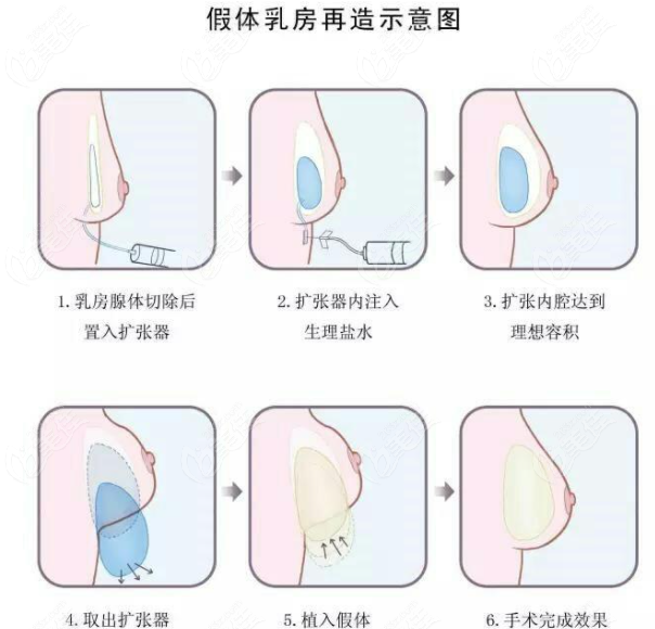 乳腺癌切除手術(shù)可以和乳房再造術(shù)可以同時一次完成嗎