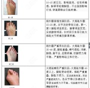 武漢大腳骨矯正好的醫(yī)院名單公布了