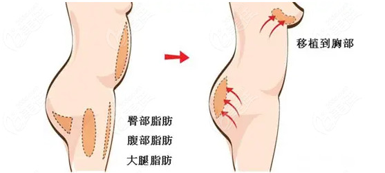 昆明做自体脂肪丰胸医院排名