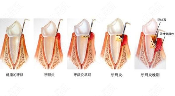 牙周炎刮治費(fèi)用是多少