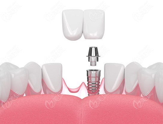 苏州口腔医院整牙、种植牙、装假牙、洗牙、拔牙、补牙等费用在此