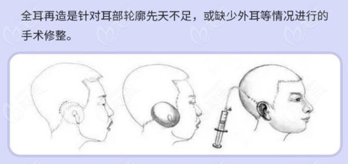 武汉五洲整形做小耳再造的是刘嘉锋医生