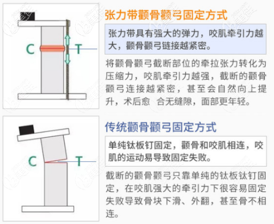 想知道颧弓手术大约多少钱吗