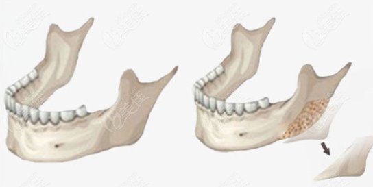 下颌角磨骨和削骨的区别是在自然度和价格上不一样吗
