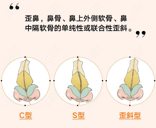 歪鼻矯正醫(yī)院哪家好