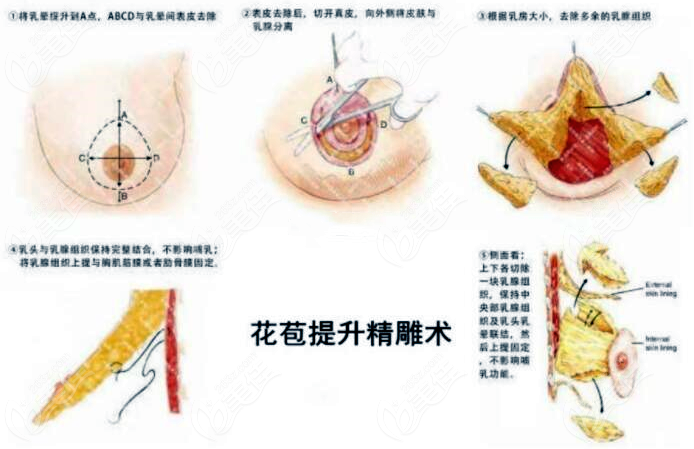 乳房花苞精雕術(shù)的價格是比傳統(tǒng)雙環(huán)貴點