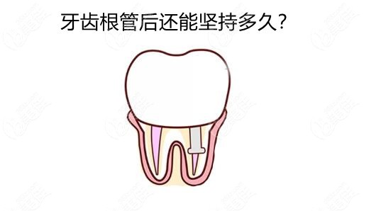 根管治疗后牙齿能用多久