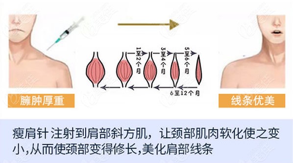 我瘦肩針一次打了200單位