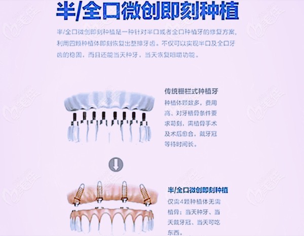 種植滿口牙檢查需要幾天及一般做完后多少天才能吃東西