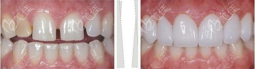 四環(huán)素牙貼面所用的琥珀瓷、藍(lán)瓷、水晶瓷和玻璃瓷在價(jià)格上的區(qū)別很大