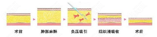 撫州吸脂瘦身好的整形醫(yī)院排名公布