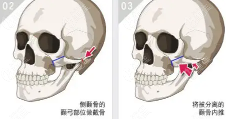 西安颧骨内推哪家医院好