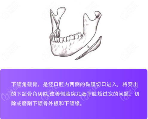 武汉下颌角磨骨好的医院排名里的都能做下颌角肥大矫正