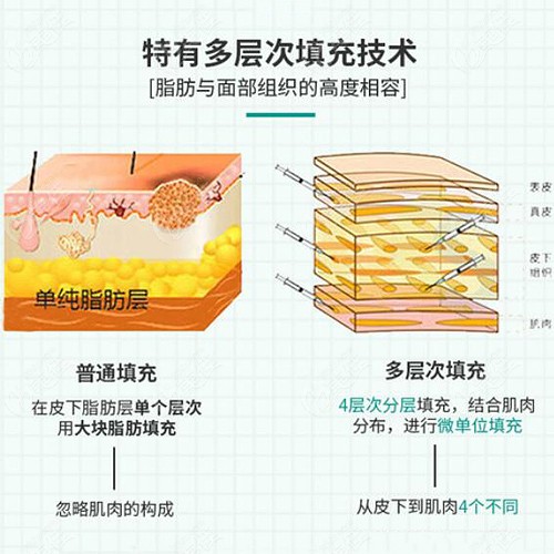 介绍银川华美整形做脂肪丰胸技术咋样时把隆胸要花多少钱也说了