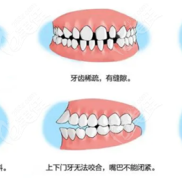 咸寧矯正牙齒大概多少錢