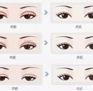 襄陽做雙眼皮修復好的醫(yī)生