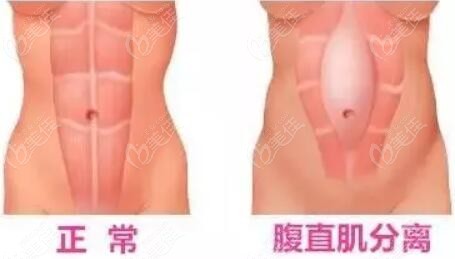 腹壁松弛一定要做腹壁成型術(shù)嗎