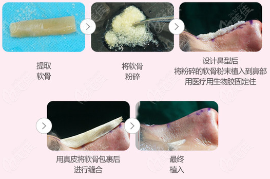 韓國gng整形做鼻子修復貴不貴