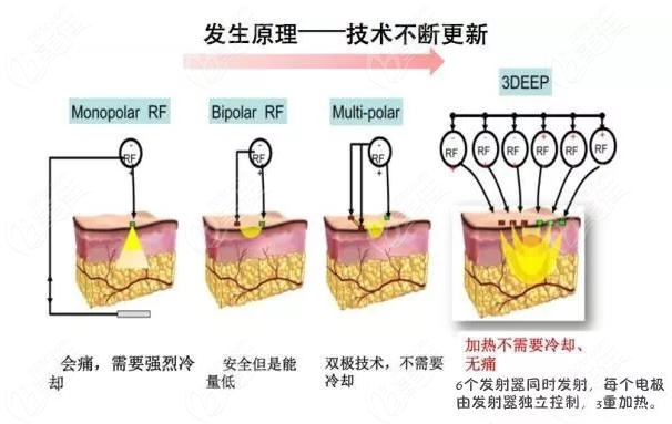 黃金微針儀器品牌哪個(gè)好