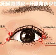 在沈陽同時做雙眼皮