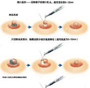 重慶當(dāng)代安可忍做縮胸手術(shù)好是真的