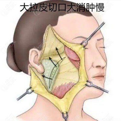 日式無痕拉皮手術(shù)和大拉皮除皺的區(qū)別在于術(shù)后消腫和維持時(shí)間不同