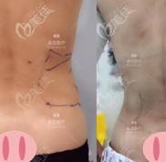 自從在南寧某家門診做了棉花糖腰腹環(huán)吸