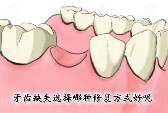 简述可摘局部义齿与固定义齿的区别