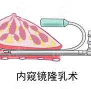 蘭州皙妍麗隆胸怎么樣