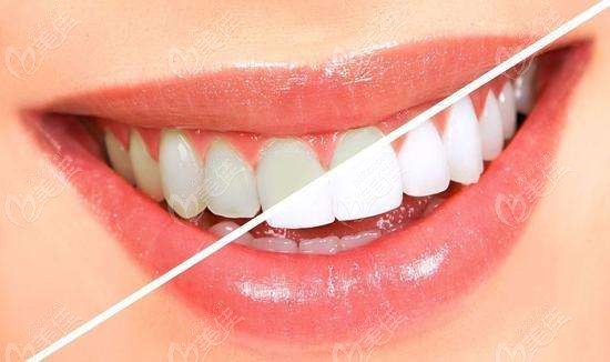 皓齿美白对四环素牙和氟斑牙有作用吗