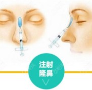 將沈陽(yáng)杏林注射玻尿酸隆鼻的費(fèi)用和做鼻子比較好醫(yī)生一并告訴你