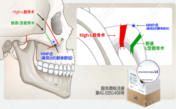 韓國id醫(yī)院High-L顴骨縮小術(shù)跟普通L型截骨有什么區(qū)別