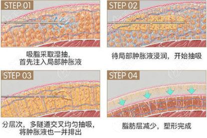 華美抽脂效果怎么樣呢