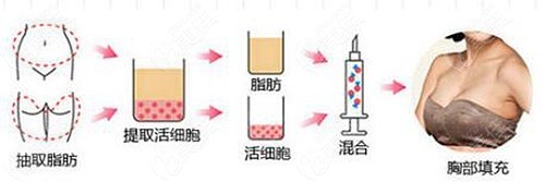 想知道洛陽做自體脂肪隆胸多少錢的